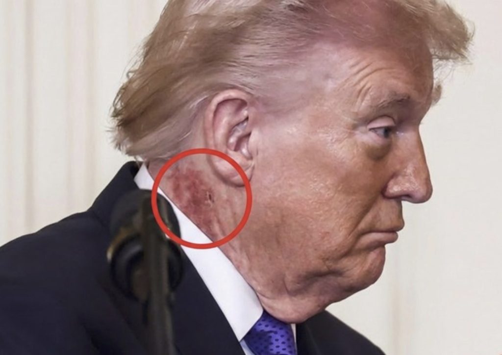 Širi se fotografija crvene mrlje na Trumpovom vratu. Javila se Bijela kuća